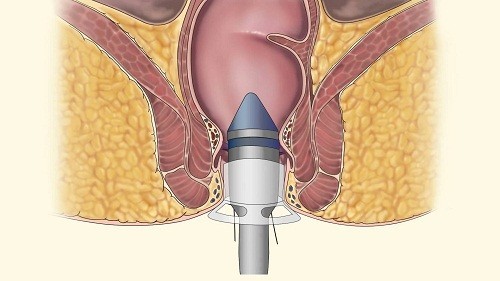 Phẫu thuật cắt trĩ theo phương pháp Longo là cách chữa bệnh trĩ nhiều ưu việt, được ưu chuộng nhất hiện nay.