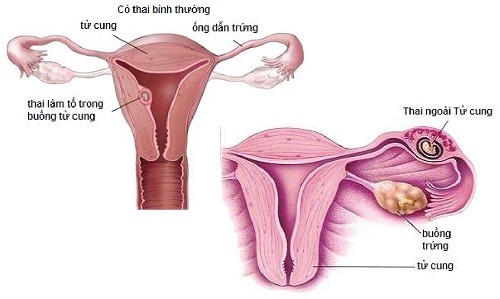 dấu hiệu mang thai ngoài tử cung