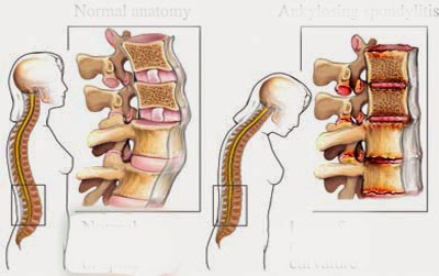 Đau lưng lâu ngày có thể là dấu hiệu cảnh báo bệnh lý cơ xương khớp.