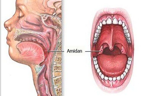 Nguyên nhân viêm amidan là những tổn thương cấp hoặc mạn tính ở bộ phận amidan có thể do vi khuẩn hoặc virus gây ra