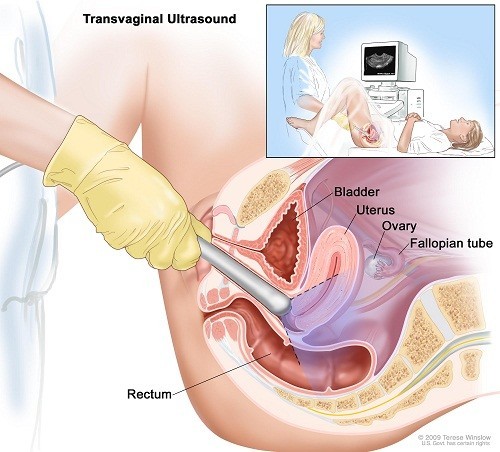 Siêu âm đầu dò âm đạo là loại siêu âm vùng chậu được các bác sĩ sử dụng để kiểm tra các cơ quan sinh dục bao gồm tử cung, ống dẫn trứng, buồng trứng, cổ tử cung và âm đạo.