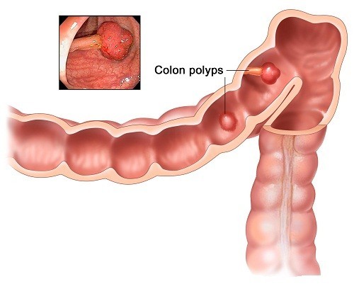 Polyp đại tràng hình thành ở lớp niêm mạc của đại tràng (ruột già).