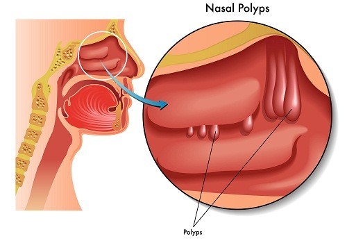 Polyp mũi là gì?