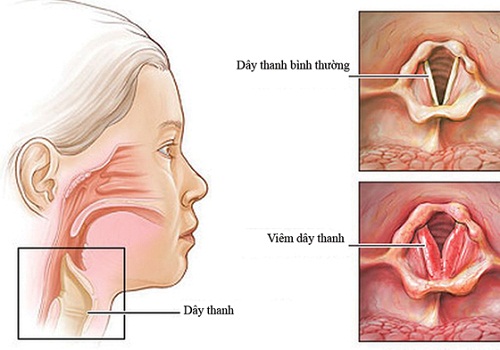 Bệnh viêm thanh quản là tình trạng dây thanh trong họng bị viêm và bị kích thích trở nên sưng lên