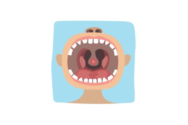 Viêm amidan có thể dẫn tới viêm họng, viêm thanh, khí, phế quản ở trẻ
