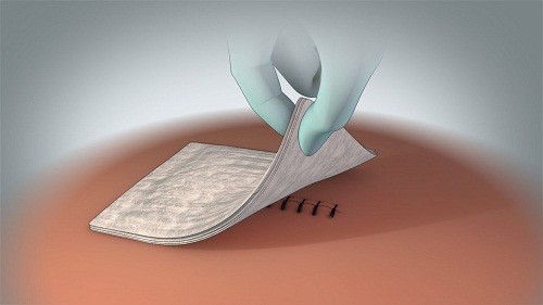 Theo dõi vết mổ là một điều cần thiết khi chăm sóc sau mổ rò hậu môn