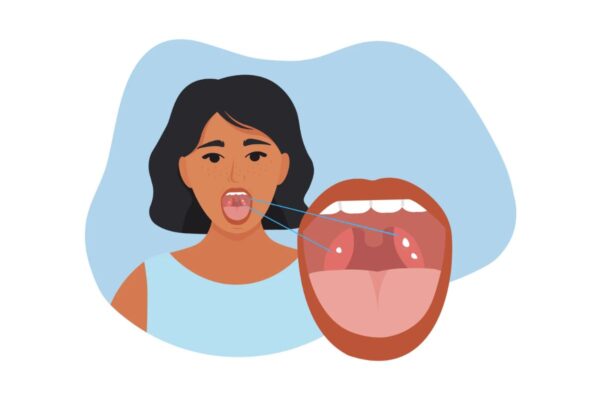Đau họng, sốt cao, hôi miệng,... là tình trạng mà người bệnh luôn gặp phải khi bị viêm amidan