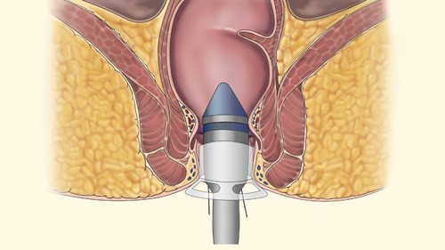 dieu-tri-tri-triet-de-sau-48-gio-tai-bv-thu-cuc.jpg2