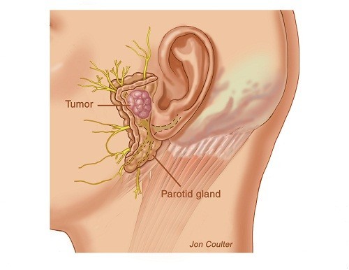 Khái quát về u tuyến nước bọt là lành tính không phải ung thư