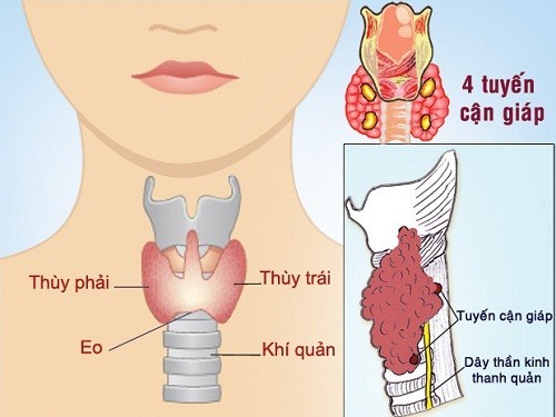 Mổ Nang Tuyến Giáp: Giải Pháp Điều Trị An Toàn Và Hiệu Quả