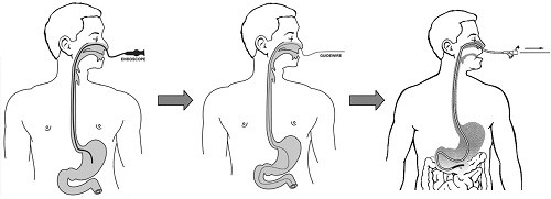 Trong nội soi dạ dày qua đường mũi, , bác sĩ sẽ đưa đưa ống soi dạ dày qua đường mũi vào thực quản rồi xuống dạ dày.