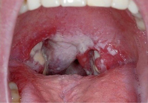 Triệu chứng viêm amidan hốc mủ thường thấy là đau họng, có mủ xuất hiện quanh amidan, hơi thở hôi