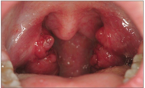Triệu chứng viêm amidan mạn tính thường xuất hiện mủ, amidan to như hai hạt hạnh nhân ở 2 bên thành họng lấn vào làm hẹp khoang họng