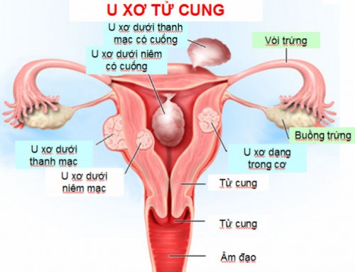 U xơ tử cung kích thước lớn bao nhiêu thì mổ