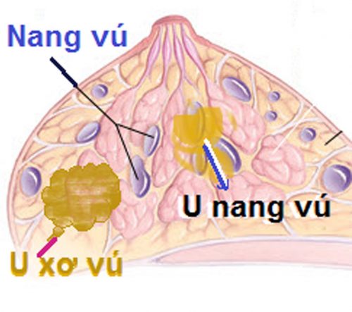 U nang tuyến vú là những túi chứa đầy nước trong vòng ngực
