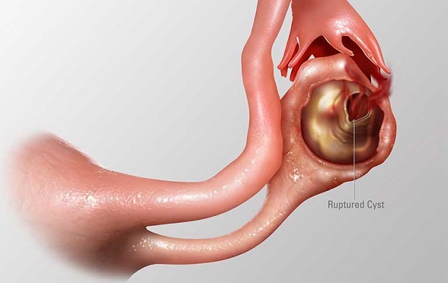 vỡ u nang buồng trứng là gì? U nang buồng trứng bị vỡ có nguy hiểm không?
