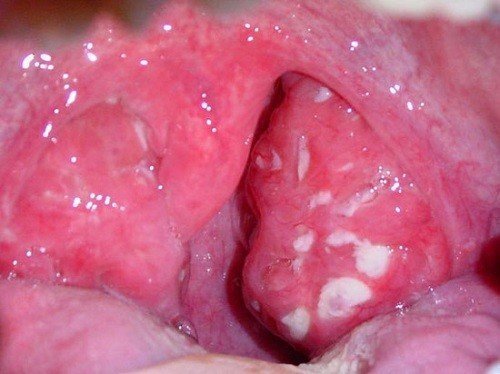 Amidan hốc mủ là tình trạng viêm nhiễm mạn tính do vi khuẩn hoặc virut, vệ sinh họng kém