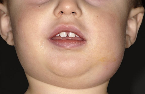 benh-quai-bi-o-tre-va-bien-chung1aBệnh quai bị ở trẻ có thể gây ra các biến chứng nguy hiểm nếu không được phát hiện và điều trị sớm
