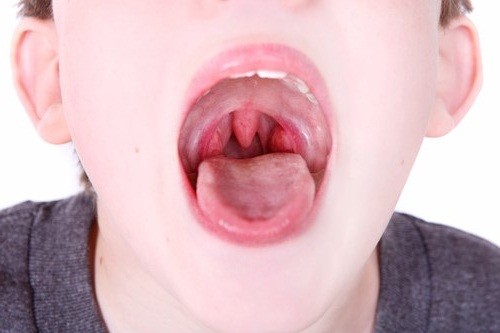 Khi bị viêm VA cấp, trẻ sẽ có biểu hiện đau rát họng, sốt cao, hắt hơi, sổ mũi...