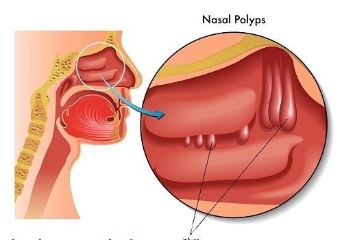 Polyp mũi hình thành từ lớp niêm mạc của mũi hoặc của các xoang