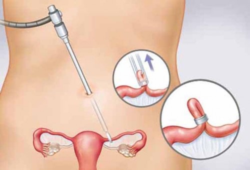 Phẫu thuật cắt bỏ tử cung nhằm cắt bỏ 1 phần hoặc hoàn toàn tử cung