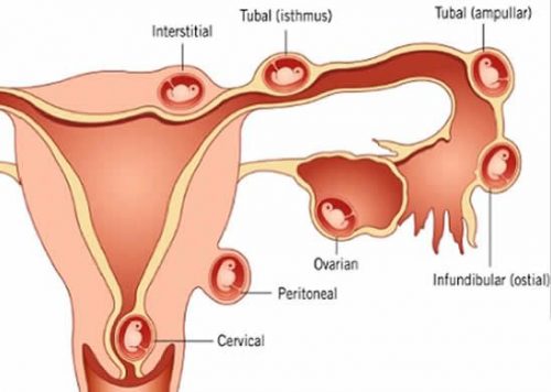 Mổ thai ngoài tử cung bao lâu quan hệ được