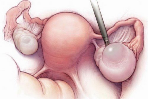 Nếu gặp u nang buồng trứng khi đang mang thai bạn cần theo dõi và thăm khám kĩ lưỡng trong suốt quá trình mang thai