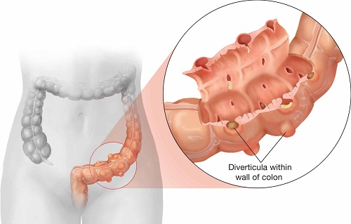 Viêm túi thừa là nguyên nhân phổ biến của đau bụng dưới bên trái và đau lưng 
