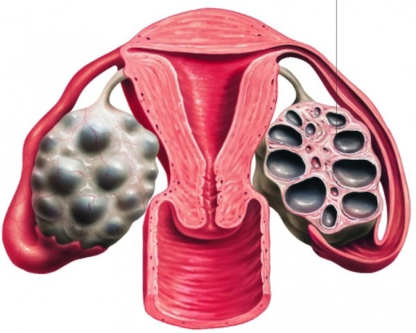 Buồng trứng đa nang là một bệnh lý nội tiết thường gặp ở phụ nữ, chiếm khoảng 16-22% số phụ nữ nói chung
