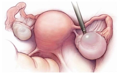 U nang buồng trứng có di truyền không
