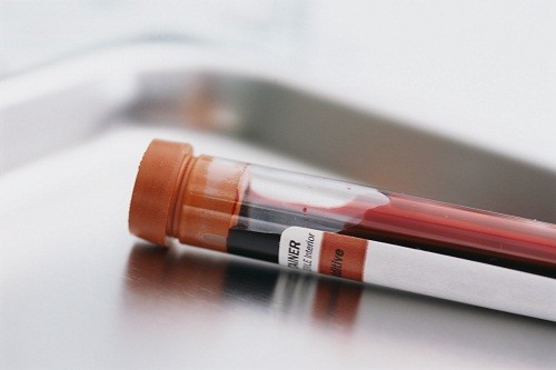 Để chẩn đoán ung thư tuyến tiền liệt, người bệnh thường được chỉ định thực hiện xét nghiệm máu tìm kháng nguyên PSA.