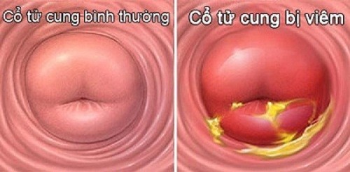 Viêm cổ tử cung nếu không chữa trị có thể dẫn đến ung thư tử cung.