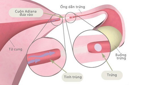viem-ong-dan-trung