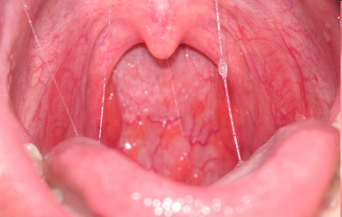 Bệnh viêm họng nguy hiểm khi có những dấu hiệu sốt cao hoặc khám thấy có mủ ở họng, cần điều trị càng sớm càng tốt