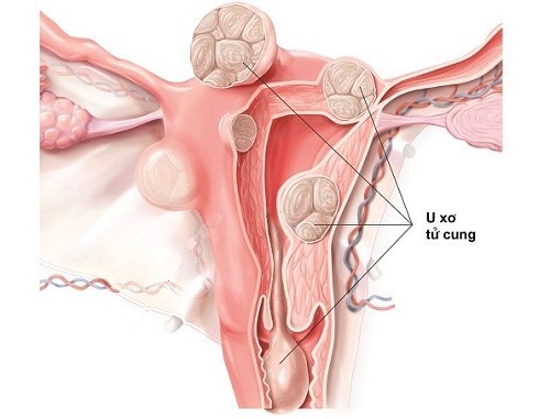 U xơ tử cung là tình trạng khối u phát triển trên thành tử cung, thường gặp ở phụ nữ trong độ tuổi từ 30-50