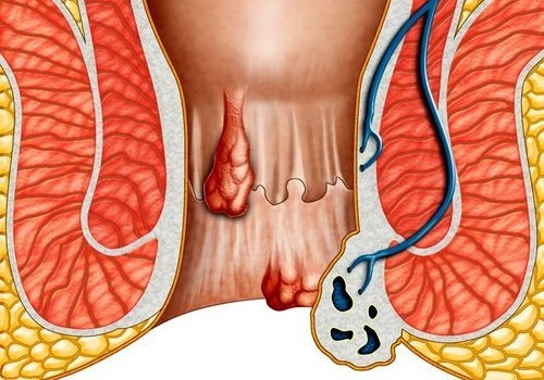 Thói quen đứng, đi hoặc nhịn đại tiện lâu ngày sẽ gây bệnh trĩ