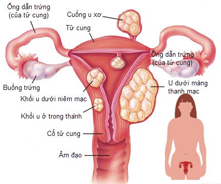 Nhân xơ tử cung 10mm