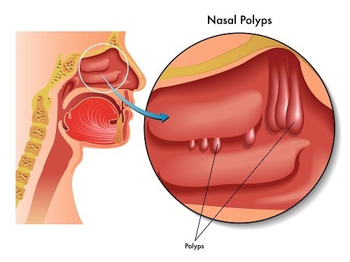 Phục hồi sau mổ polyp mũi