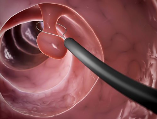 Polyp cổ tử cung là những u nhỏ, có thể xuất phát từ cổ tử cung ngoài hay từ cổ tử cung trong, thò ra lỗ ngoài cổ tử cung.