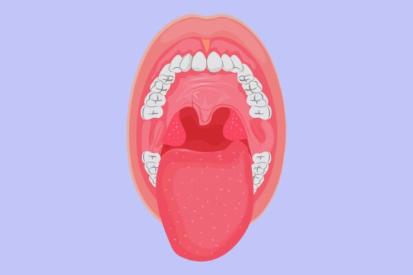 Viêm amidan hốc mủ là một thể viêm amidan nghiêm trọng, ảnh hưởng không nhỏ tới sức khỏe của người bệnh
