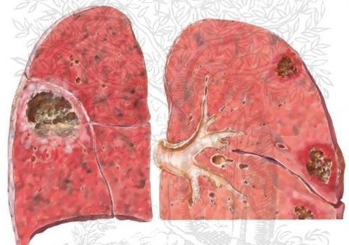 Bệnh xơ phổi là tình trạng tổn thương mạn tính mô ở sâu bên trong phổi làm cho mô phổi bị dày lên
