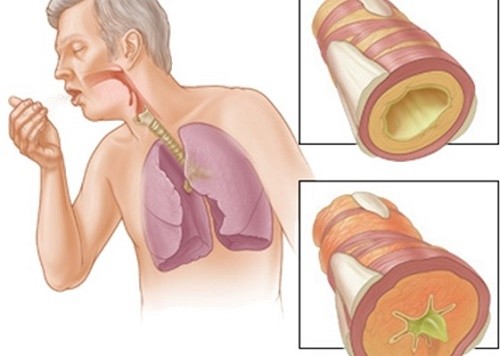 Người bệnh bị xơ phổi thường có triệu chứng ho kéo dài, ho ra máu, đau tức ngực...