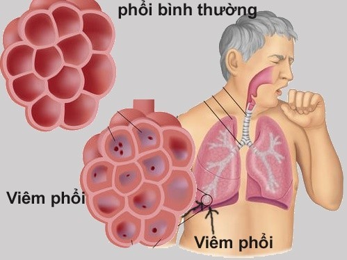 Viêm phổi, viêm phế quản...là những bệnh lý dễ lây qua đường hô hấp, ảnh hưởng nghiêm trọng tới sức khỏe