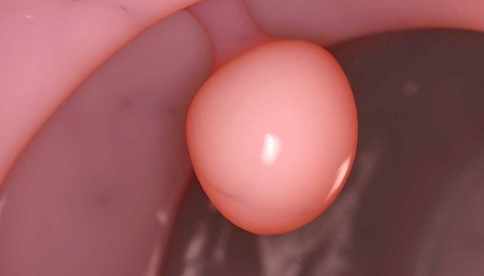 Khí huyết trắng loãng như nước cảnh báo nguy cơ mọc polyp ở chị em