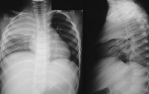 Viêm mủ màng phổi là sự tràn mủ trong khoang màng phổi và có thể gây ra các biến chứng nguy hiểm