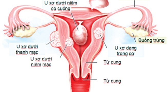 Bệnh u xơ tử cung gây vô sinh không