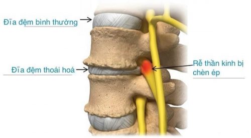 Mất nước đĩa đệm là một trong những biểu hiện của quá trình lão hóa đĩa đệm.