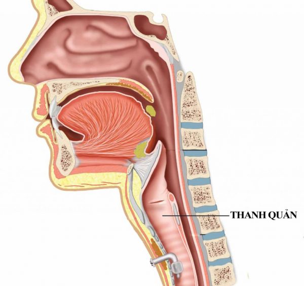 Hẹp thanh quản là tình trạng đường thở bị chít hẹp ở các mức độ khác nhau bắt đầu từ nắp thanh quản cho đến khí quản.