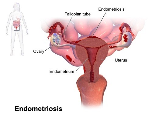 Lạc nội mạc tử cung là một bệnh trong đó các mô bình thường phát triển bên trong tử cung lại xuất hiện bên ngoài tử cung.