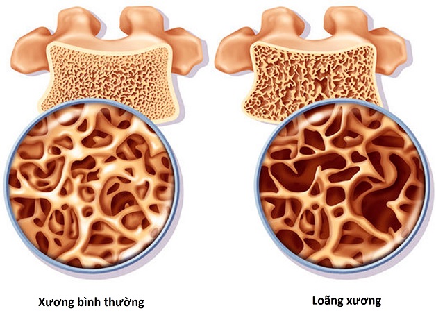 loãng xương ở trẻ